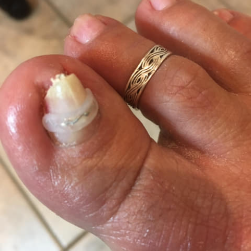 Bøjle på nedgoet negl – behandling af fodplejer i Ullerslev